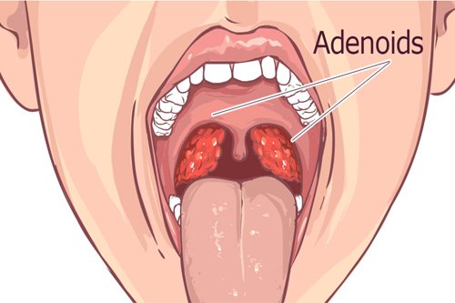 Adenoidectomy similar like tonsils open mouth show