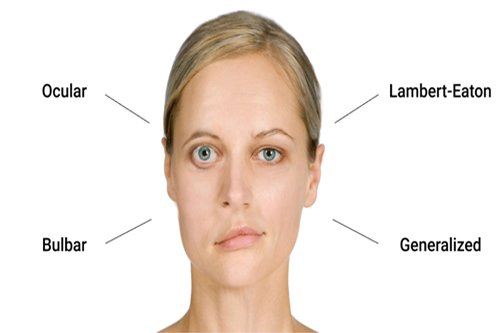 Myasthenia gravis face eyes chin shrink patient