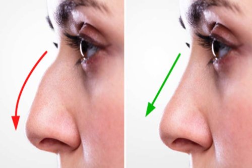 Septoplasty shows after before effect