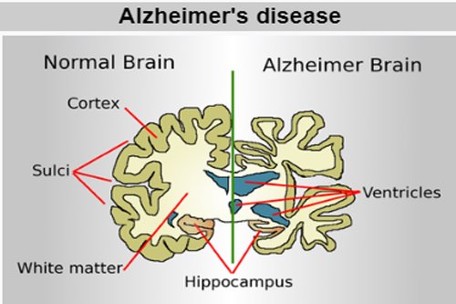 Alzheimer's disease explain through design