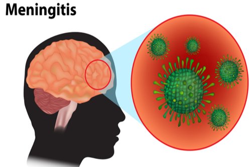 meninigits
