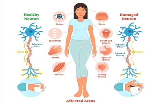 Multiple sclerosis disease explain in details