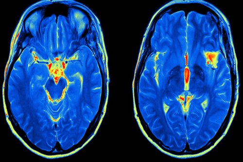 Neuroimaging in Chhindwara