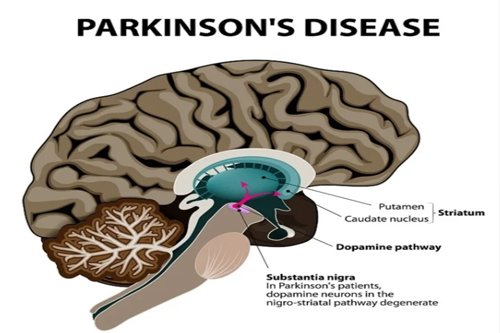 Parkinson's disease detail explain brain part