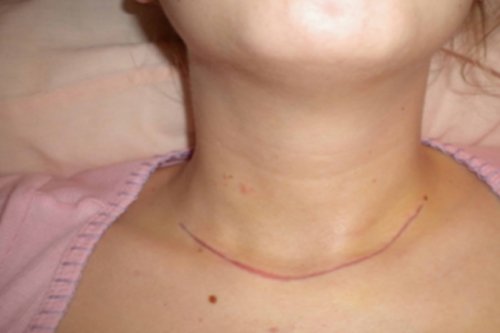 Thyroid Surgery show streactes in Nagpur