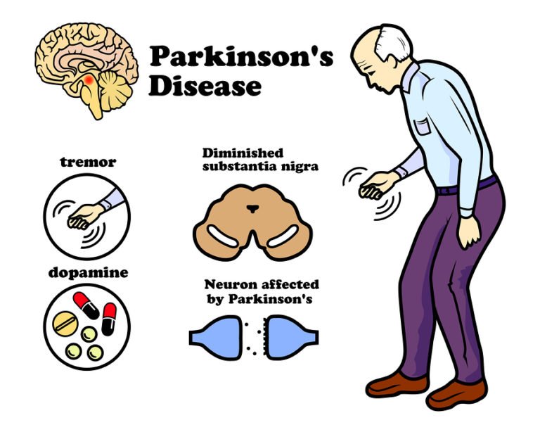 Parkinson's
