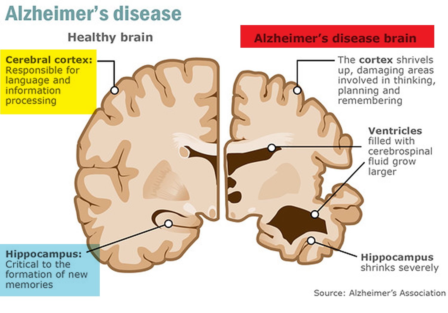 Alzheimer’s Disease
