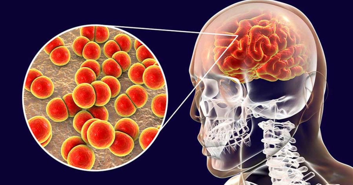 Meningitis encephalitis in Betul