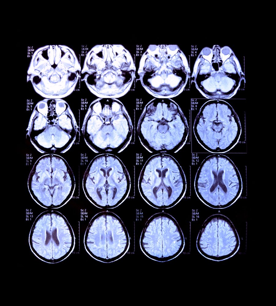 Neuroimaging