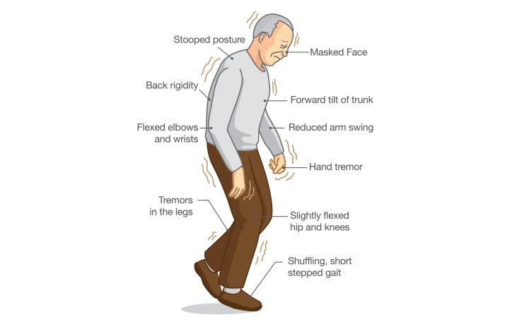 Movement Disorders in Chhindwara
