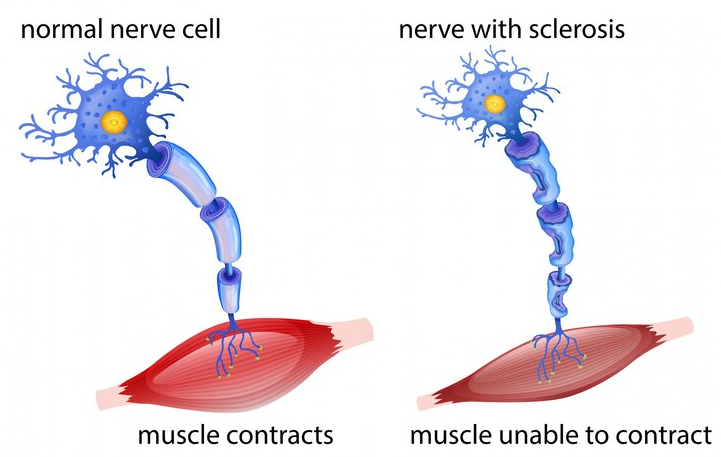 multiple sclerosis